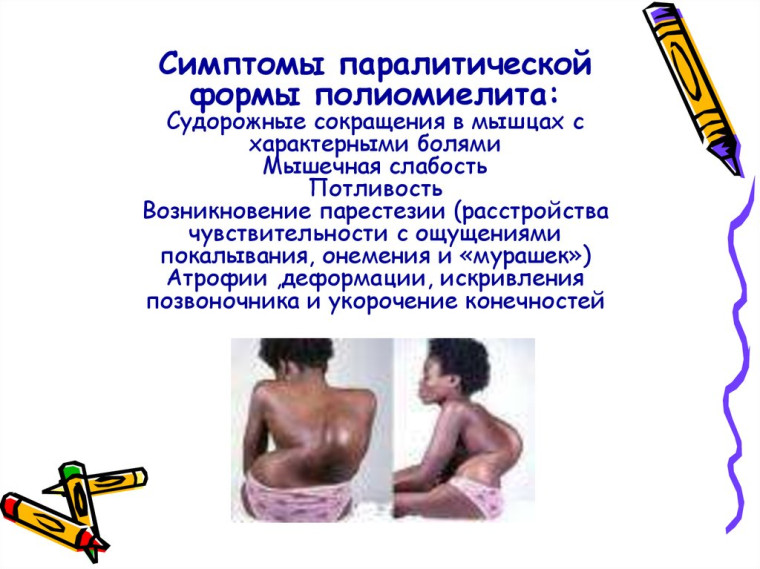 Расскажем Вам об инфекционном заболевании полиомиелита . Расскажем Вам об инфекционном заболевании полиомиелита .